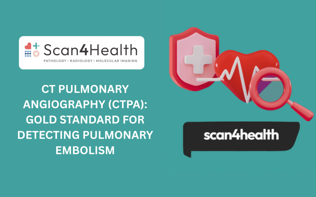 CT Pulmonary Angiography (CTPA): Gold Standard for Detecting Pulmonary Embolism