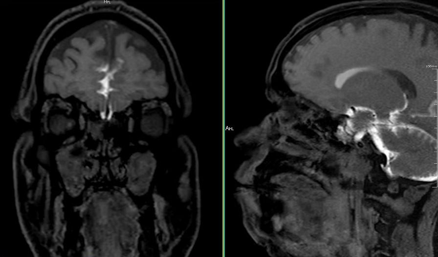 MRI Cisternography for CSF Rhinorrhea: This emphasizes how adv MRI protocols can guide clinicians toward the right management approach.