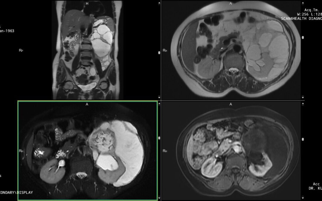 Re-defining Clarity in Diagnosis: MRI KUB in a challenging Retroperitoneal Case.