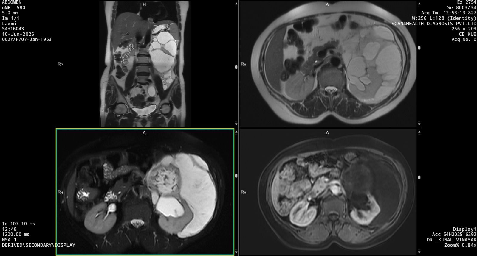 Onco Imaging Case Image MRI KUB Retroperitoneal Case